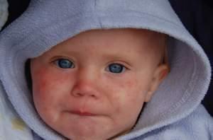 A young child with measles.